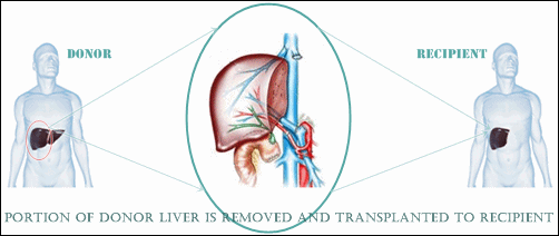 liver transplant